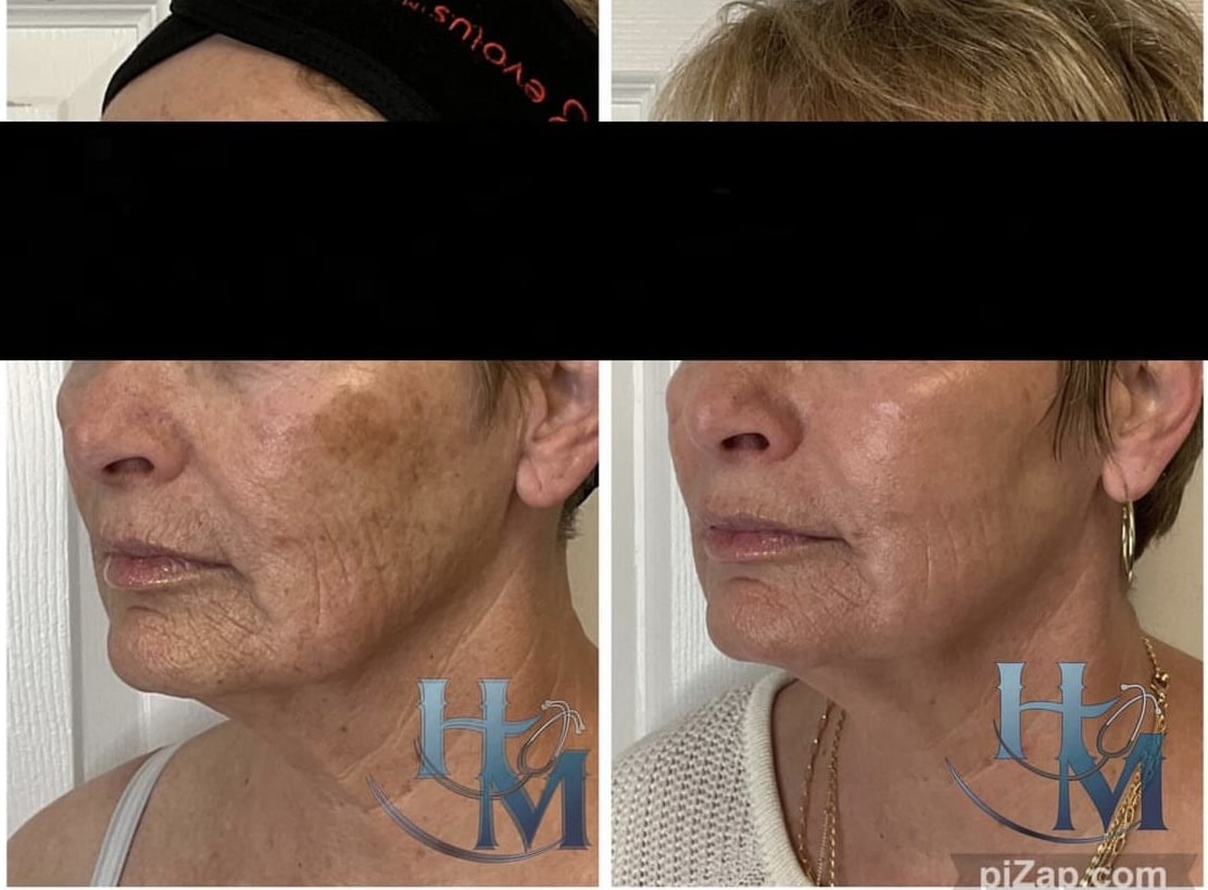 Before and After Image: Morpheus8 and Lumecca - left-front-oblique