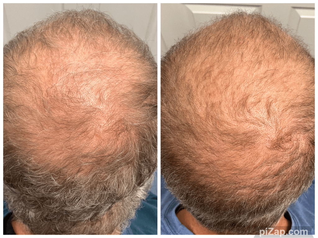 Before and After Image: TED - back