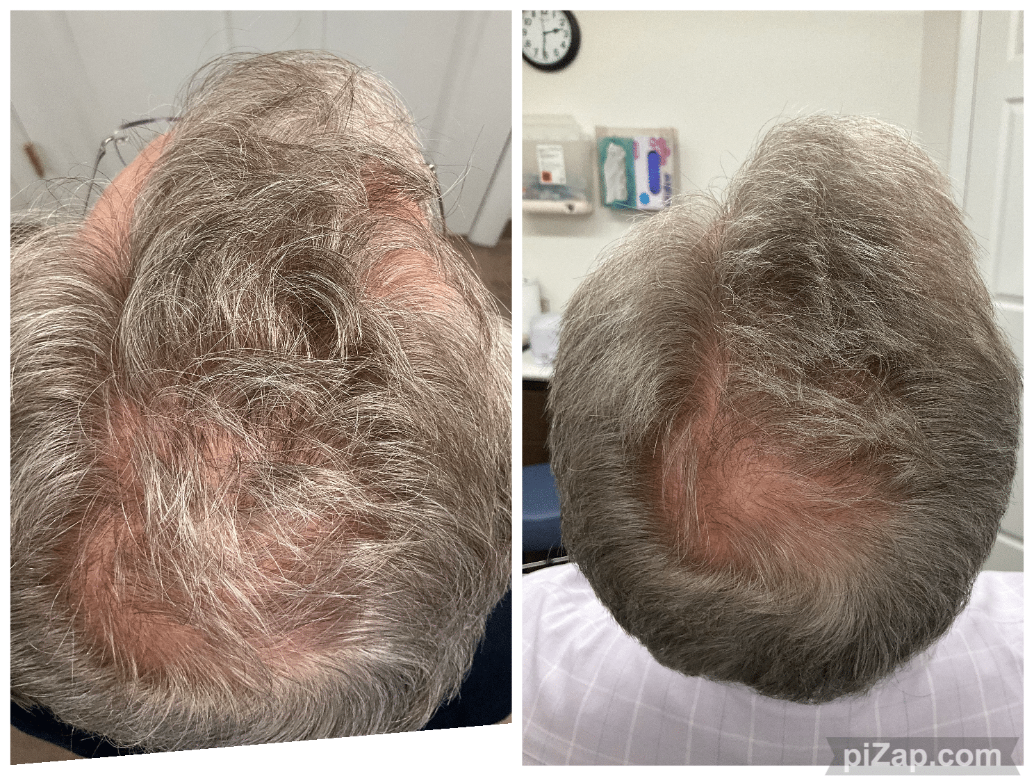 Before and After Image: TED - back