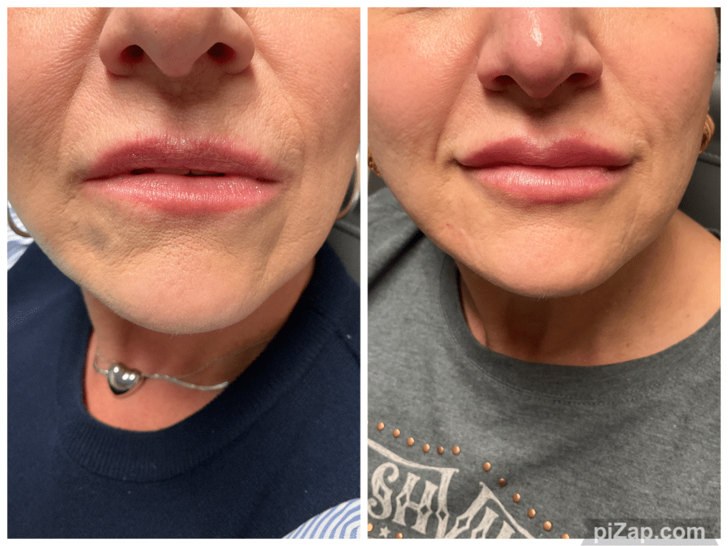 Before and After Image: Evolysse - front
