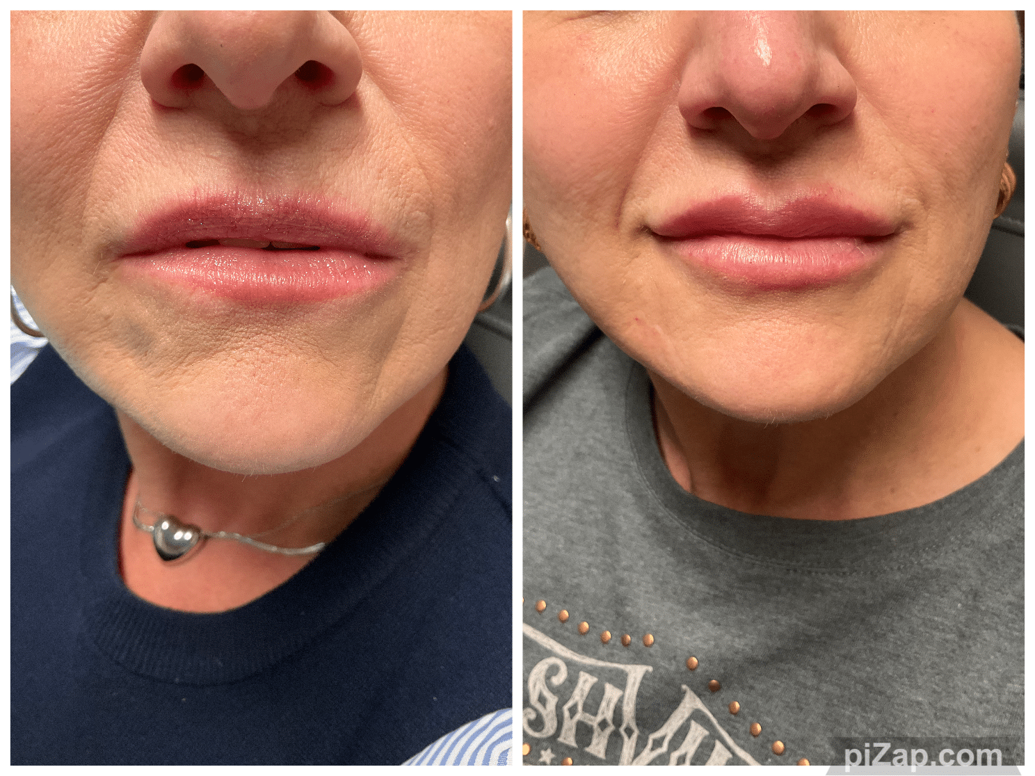 Before and After Image: Evolysse - front