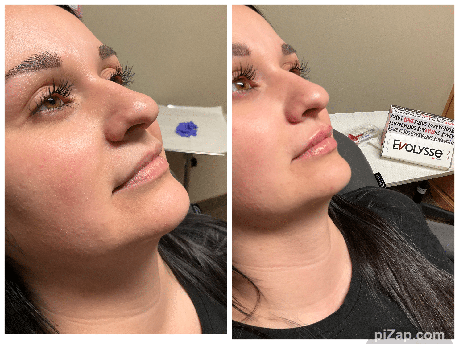 Before and After Image: Evolysse - right-front-oblique