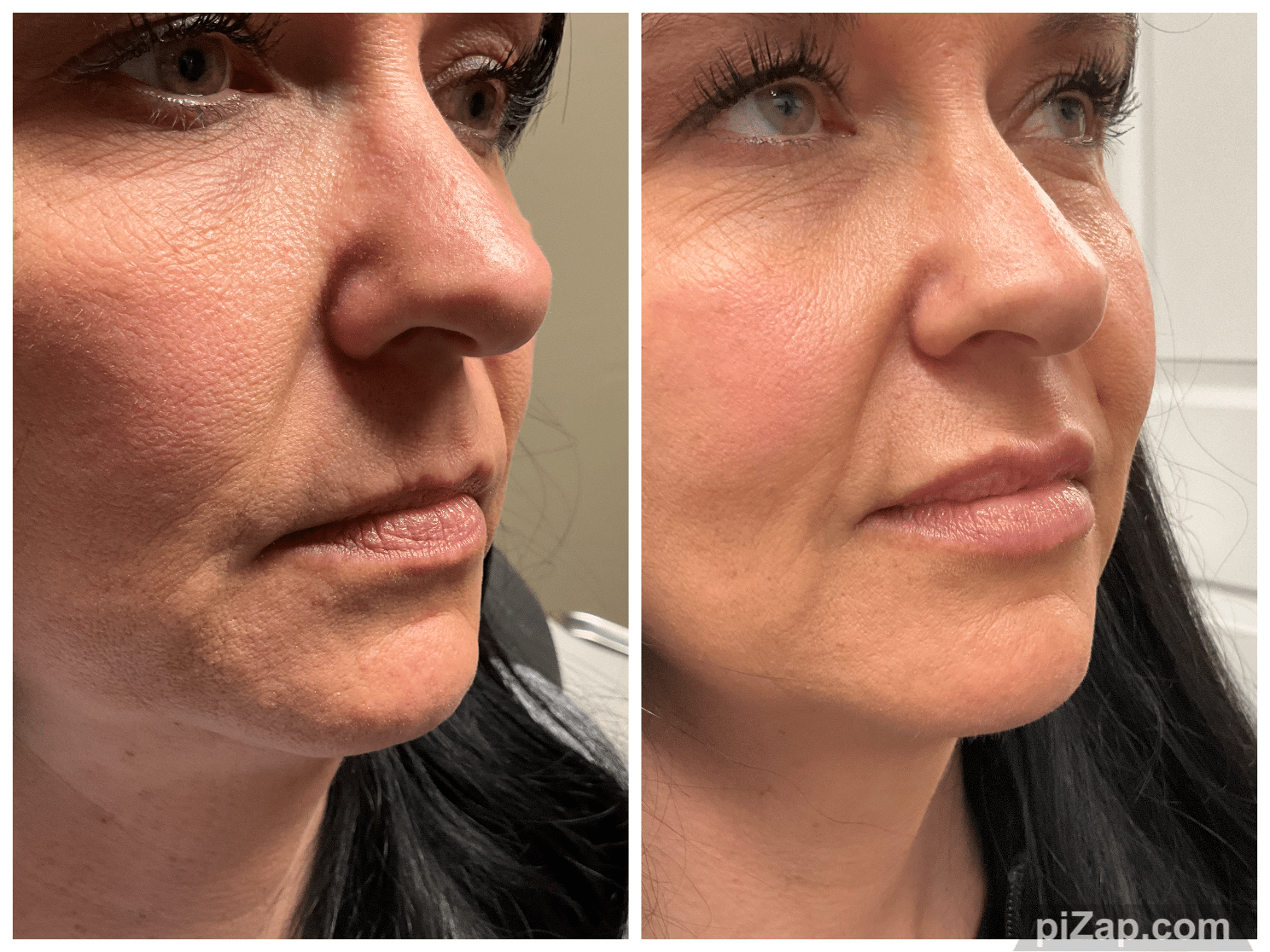 Before and After Image: Evolysse - right-front-oblique