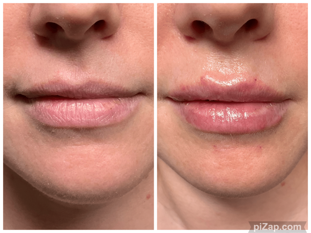 Before and After Image: Evolysse - front