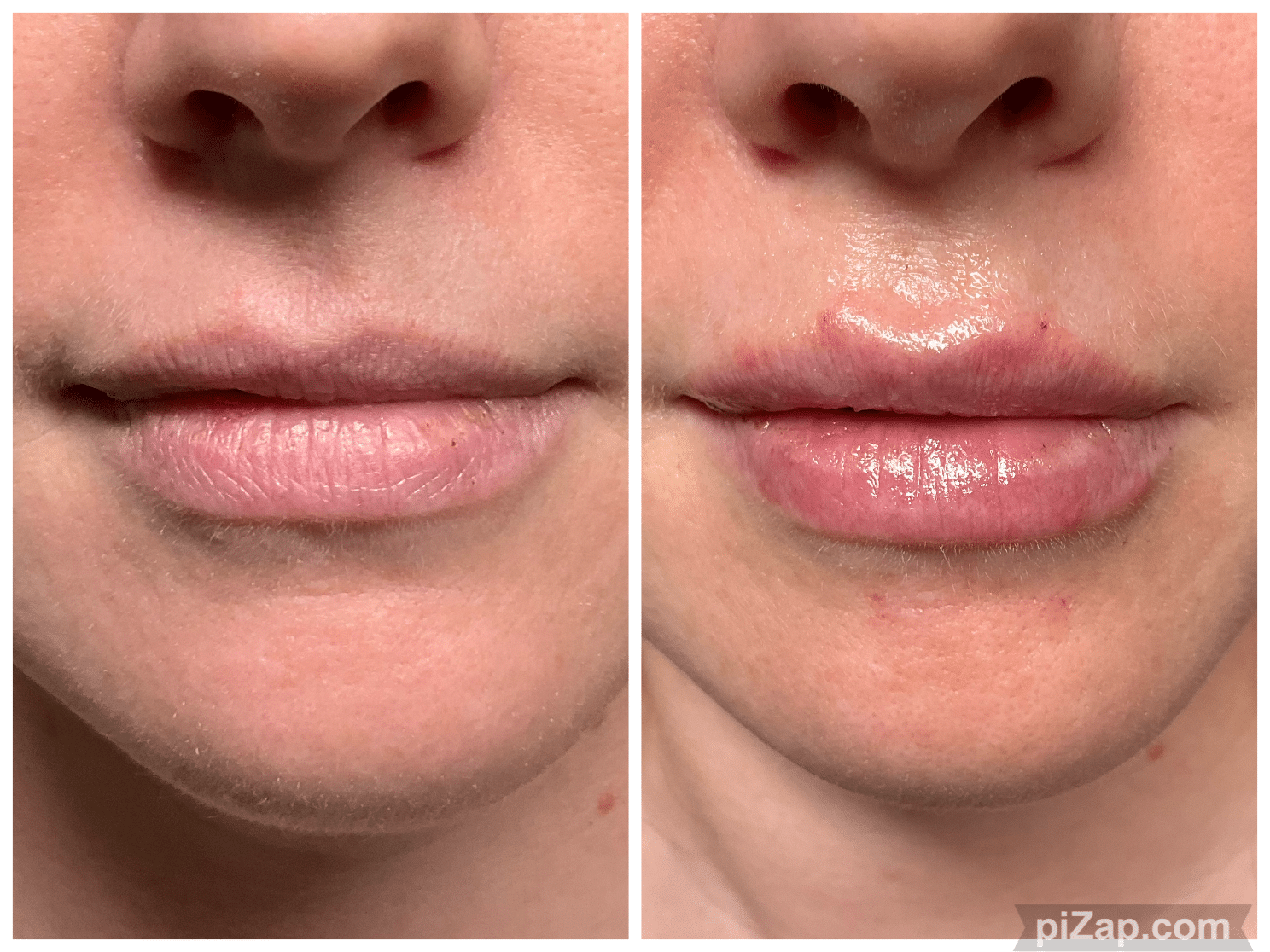 Before and After Image: Evolysse - front