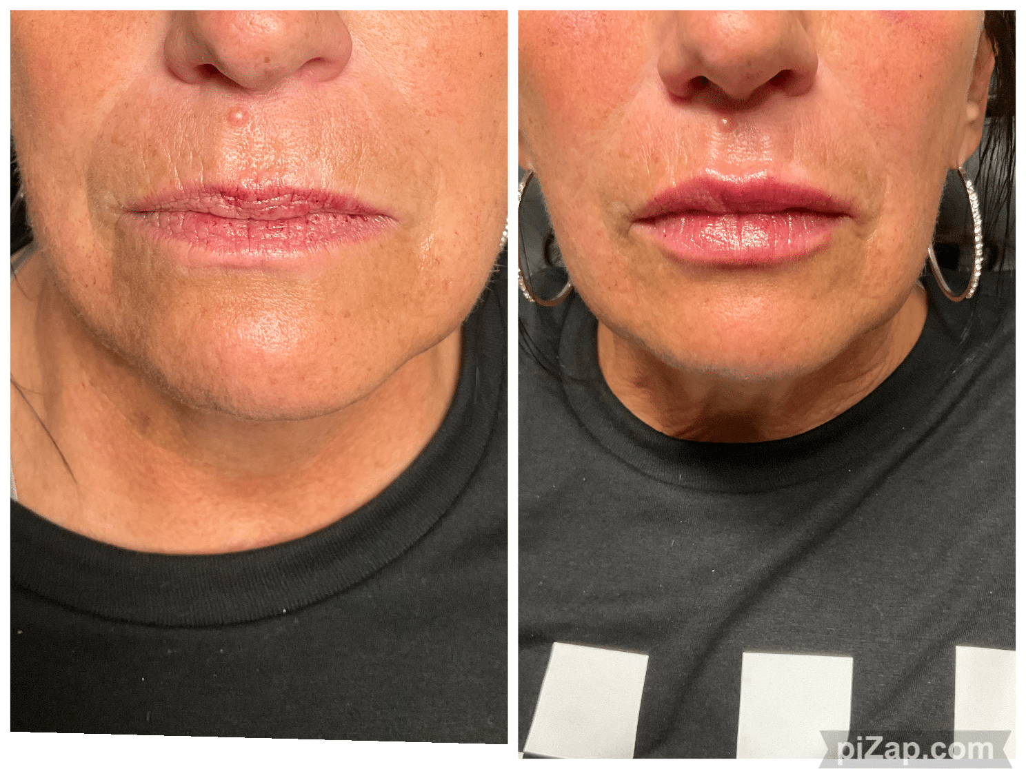 Before and After Image: Evolysse - front