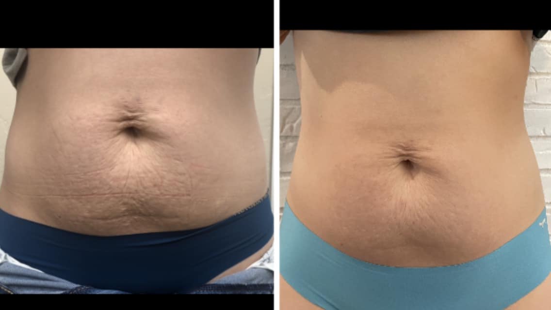 Before and After Image: Morpheus8 - front