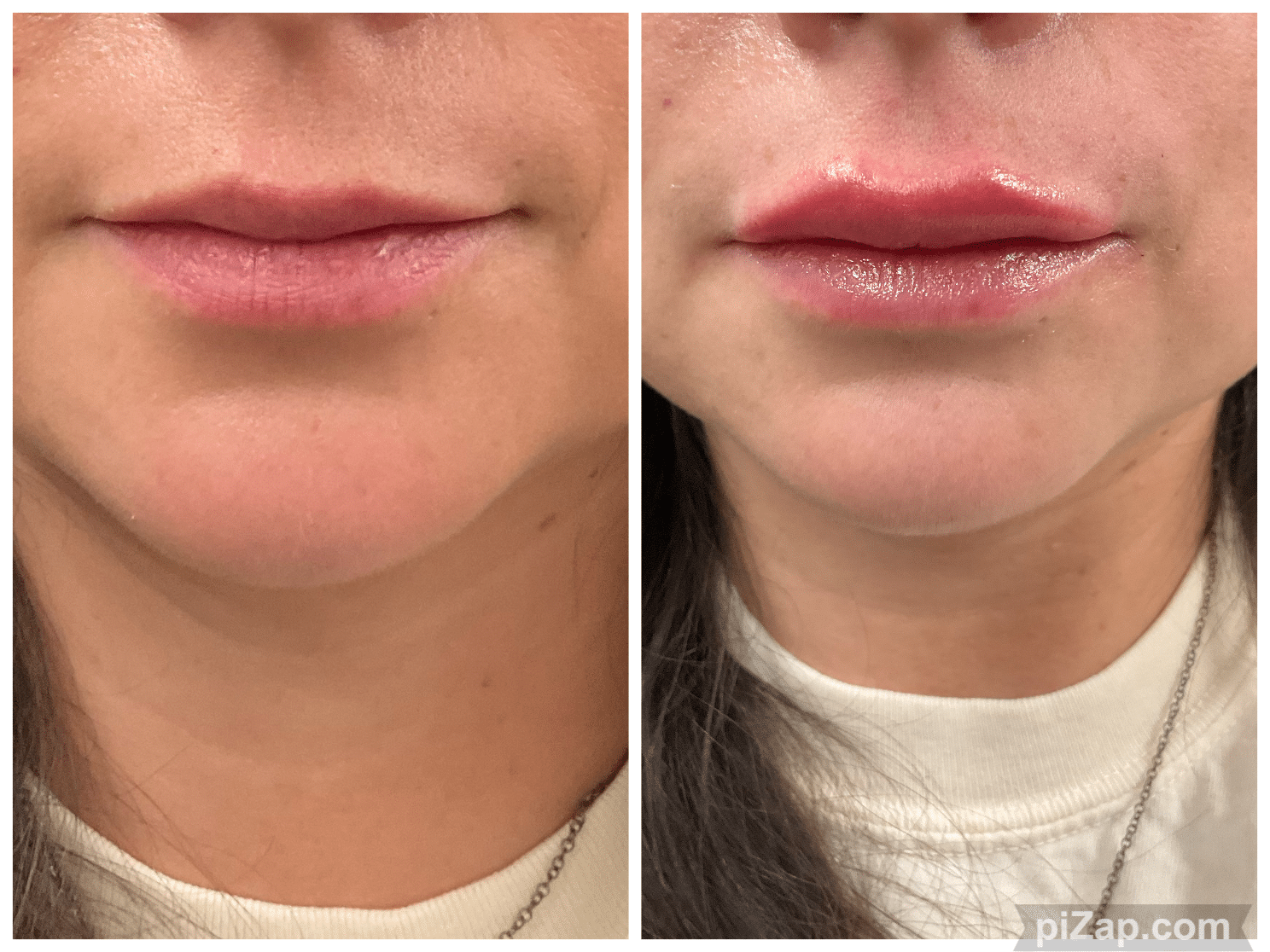 Before and After Image: Evolysse - front