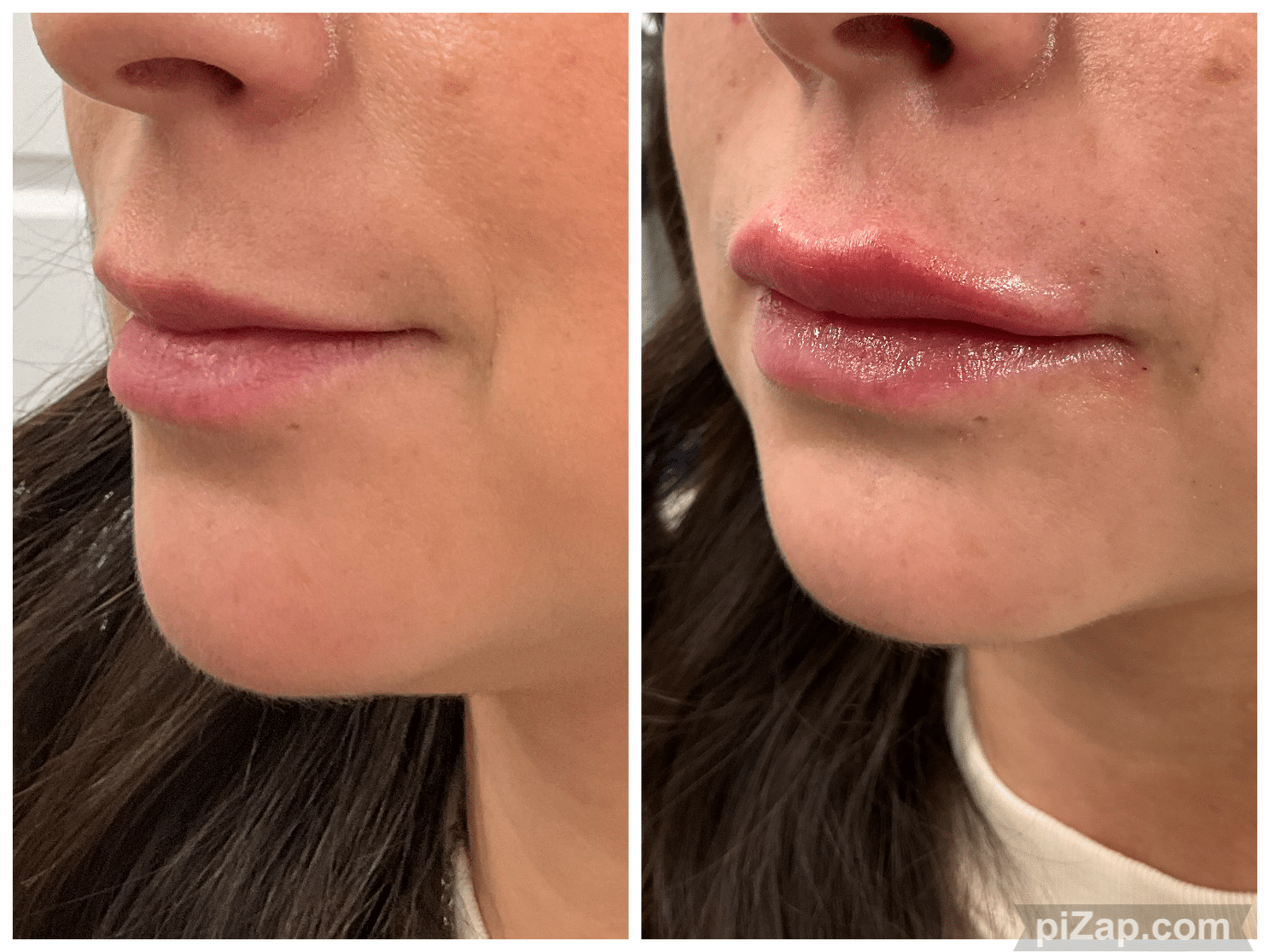 Before and After Image: Evolysse - left-front-oblique