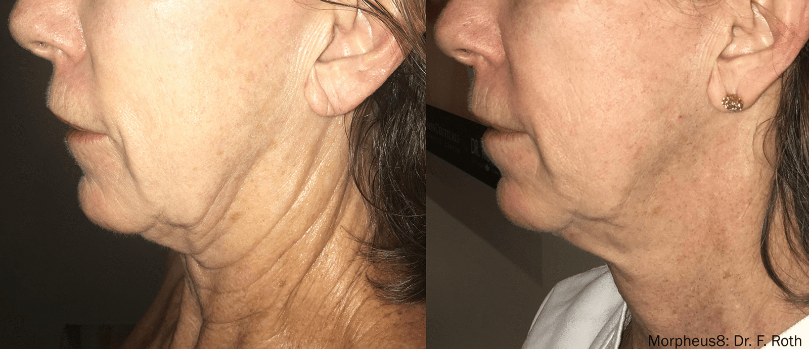 Layer-0 Body Contouring in Burley, ID