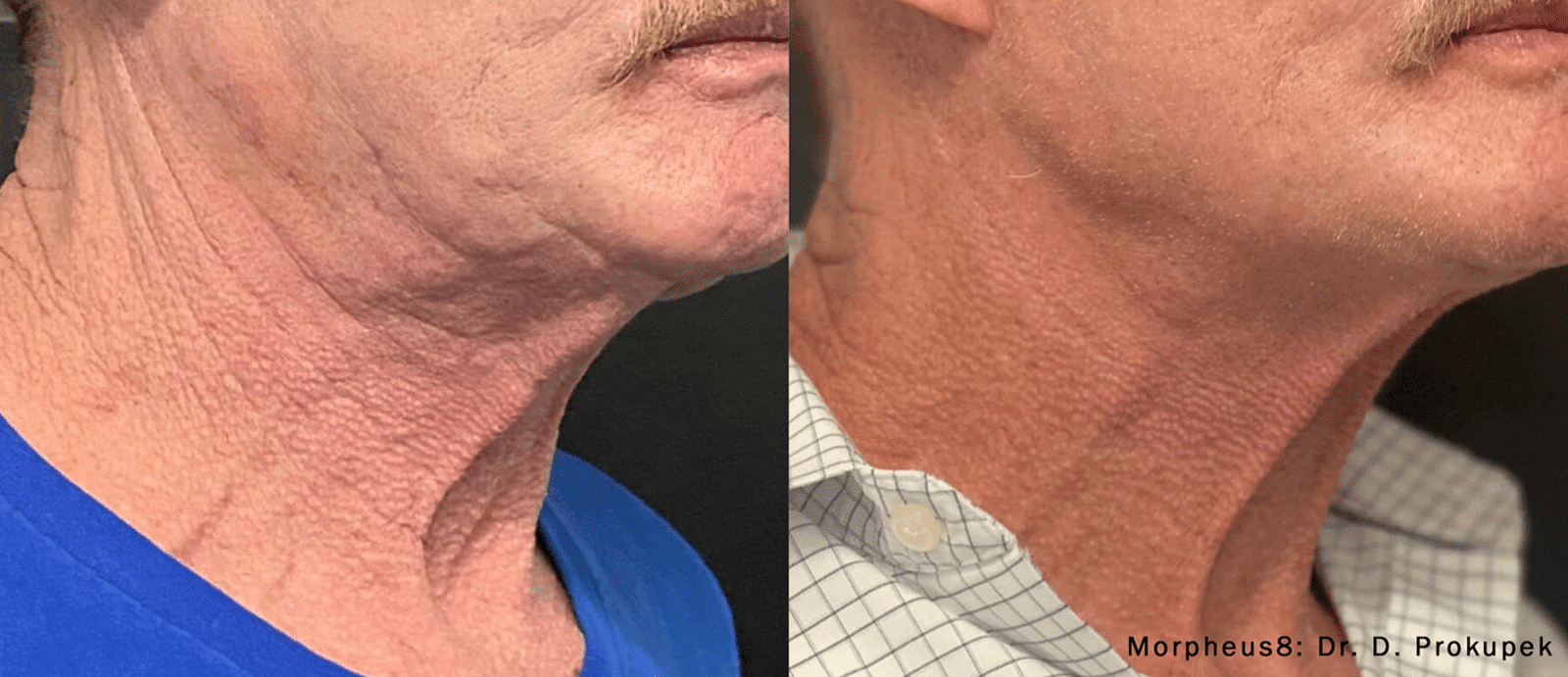 morpheus8-before-after-dr-d-prokupek-preview-1-1 Body Contouring in Burley, ID